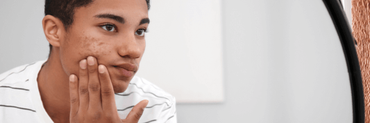 man looking in mirror touching cheek with chronic acne